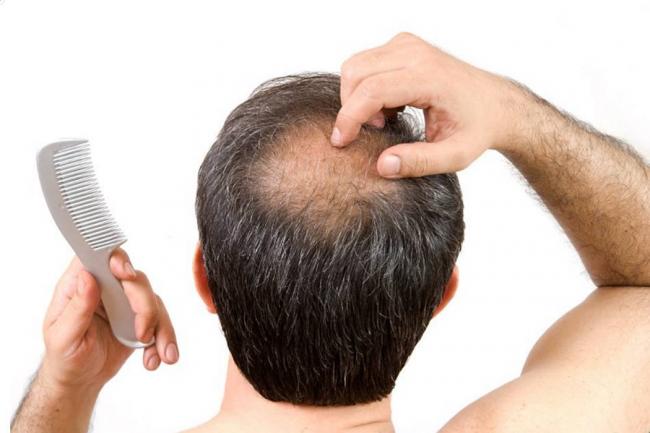 Alopecia-Enfermedad cuero cabelludo