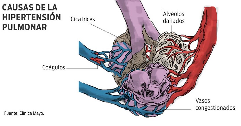 Causas de la hipertensión pulmonar